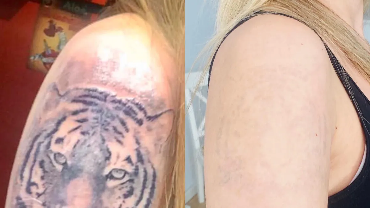 Franquicia Select Laser Tattoo - Estética, Belleza y Peluquería - ZonaFranquicia